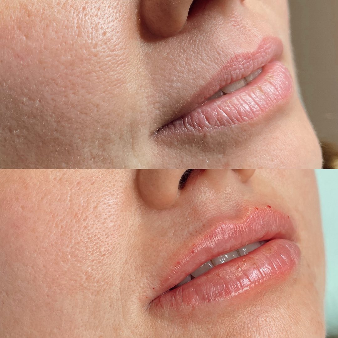 Uwielbiamy taki efekt - subtelnie nawilżone usta! 👄 Jak Wam się podoba? ☺️
Usta wykonała Dr n. med. Kinga Adamska @marrieddoctors 👩🏼⚕️
👉🏼 Efekt zabiegu może się różnić w zależności od indywidualnych cech pacjenta, liczby powtórzeń zabiegu, stosowania się pacjenta do zaleceń pozabiegowych oraz umiejętności i doświadczenia osoby przeprowadzającej zabieg.
#MEDISTIC #medycynaestetyczna #nawilzenieust #usta #nawilżanie #nawilżenie #modelowanieust #medycynaestetycznapoznan #poznan #poznań #gabinetylekarskie #gabinetylekarskiepoznań
